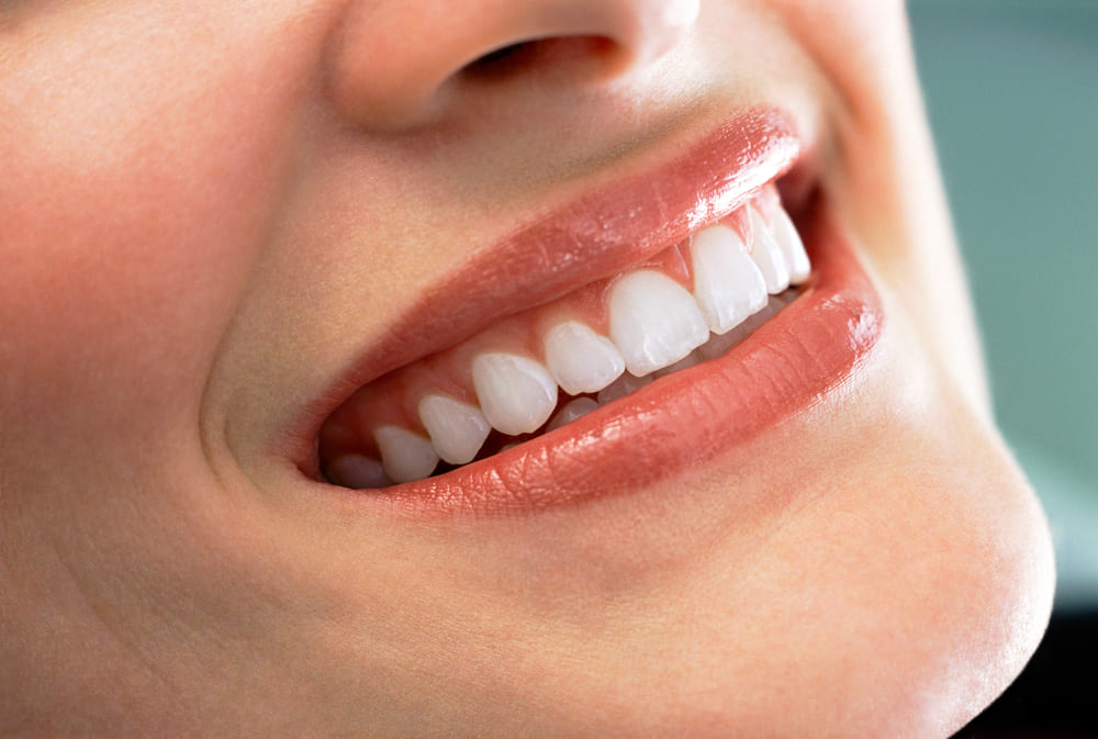 carillas dentales