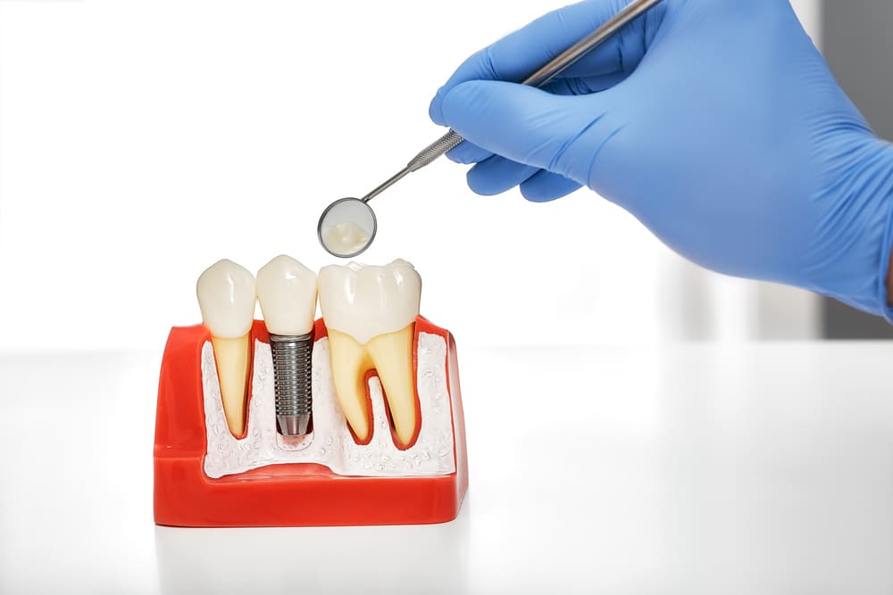 implantes dentales