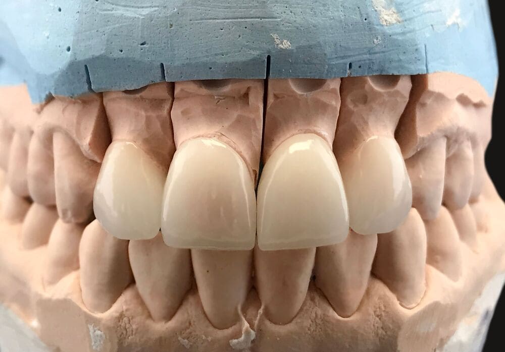 carillas dentales