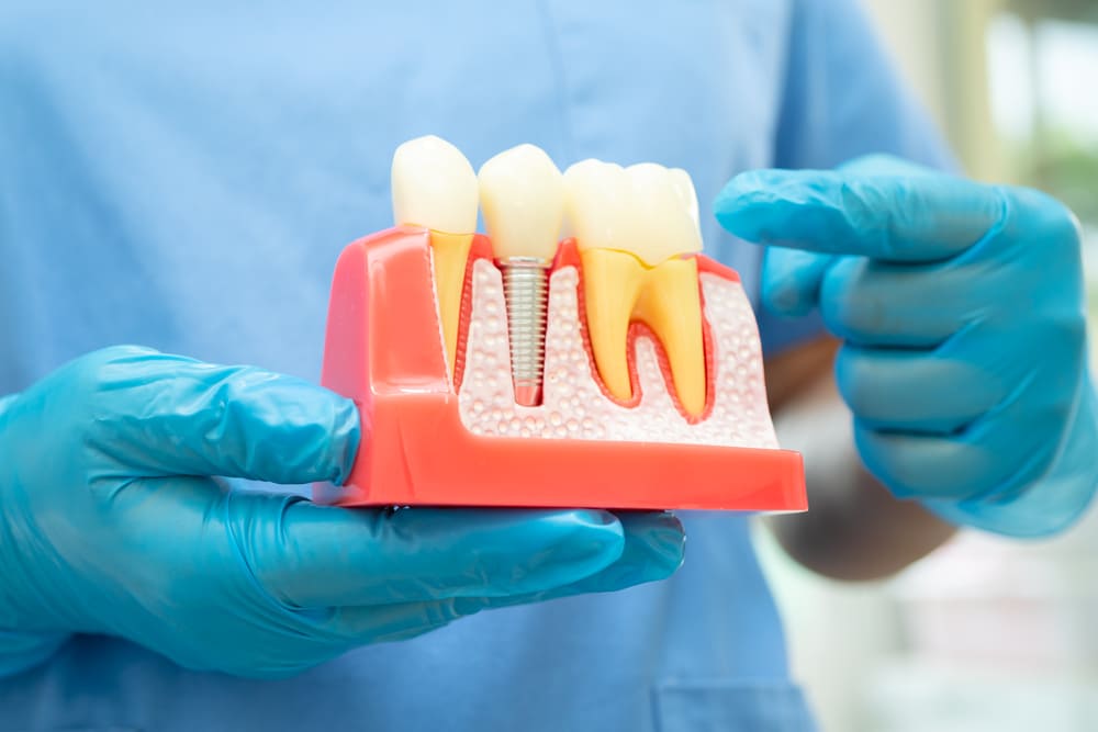 implante dental en Panamá