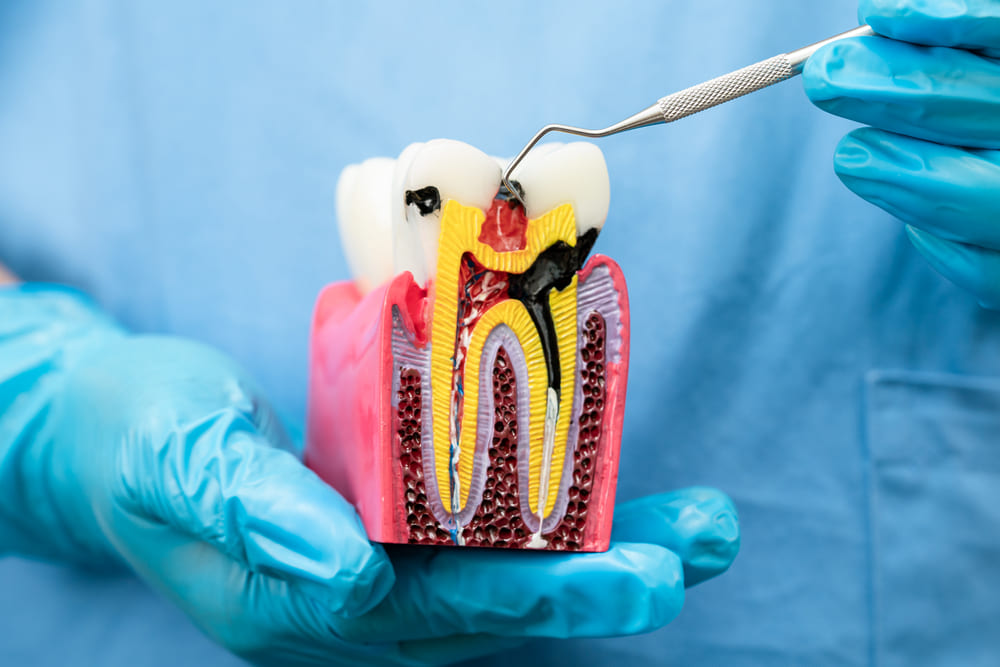 especialistas en endodoncia en Panamá