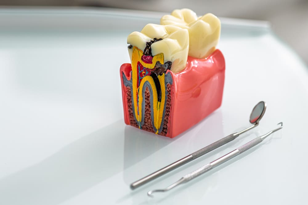 Endodoncia en Panamá: tratamiento para cuidar y conservar los dientes
