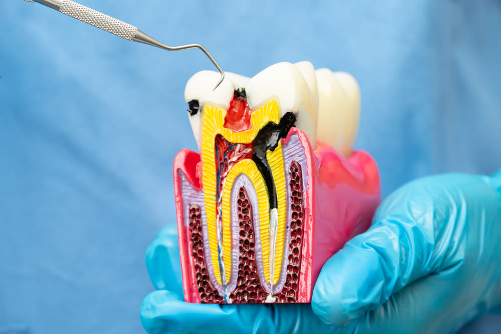Endodoncia en Panamá: una opción para tratar infecciones dentales