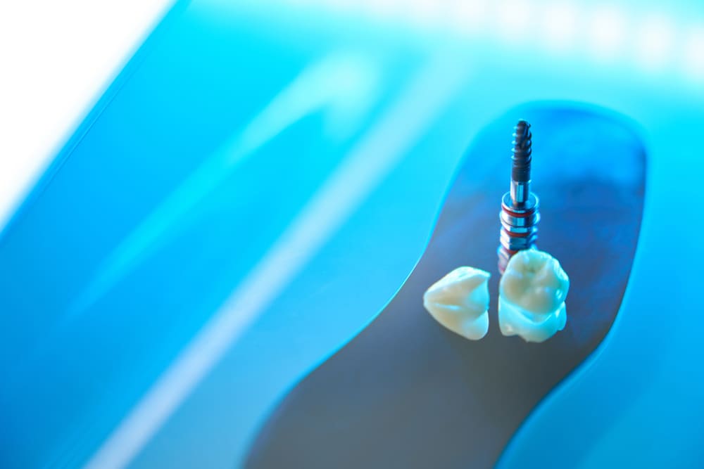 Tratamientos odontológicos integrales en rehabilitación oral completa en Panamá