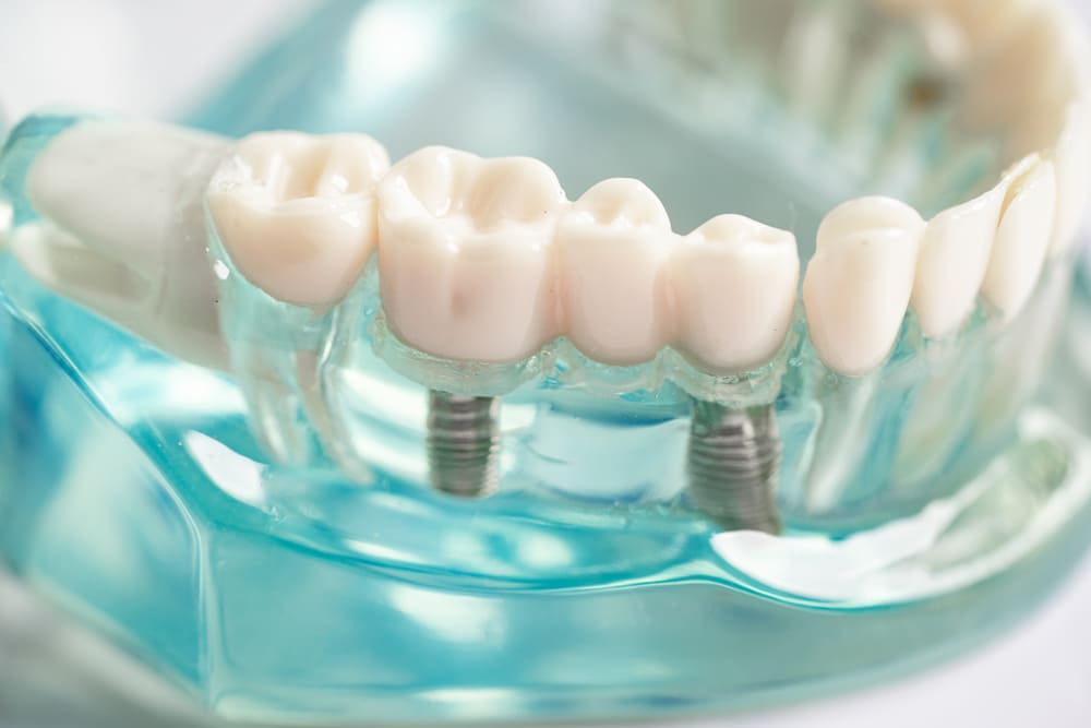 Pasos clave para una rehabilitación oral completa exitosa en Panamá