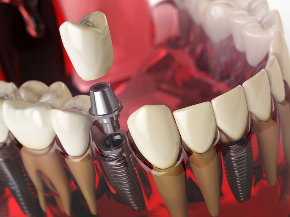 Soluciones para pérdida y desgaste dental con rehabilitación oral completa en Panamá