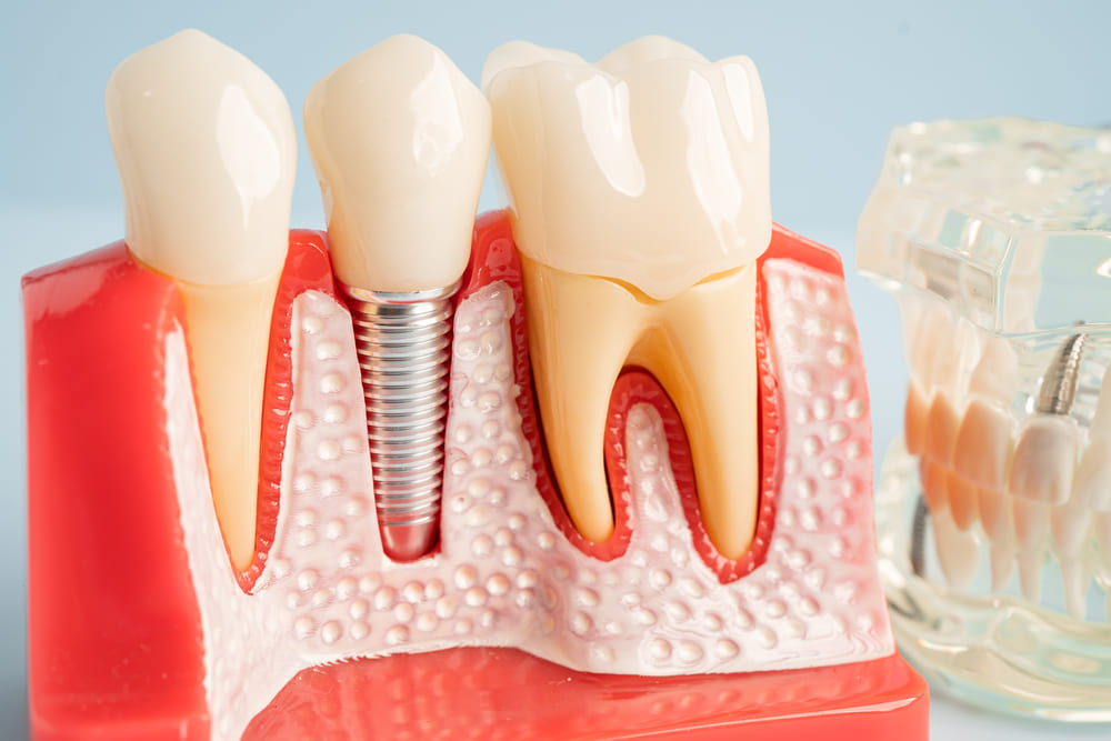 La importancia de la valoración dental antes de la rehabilitación oral completa en Panamá
