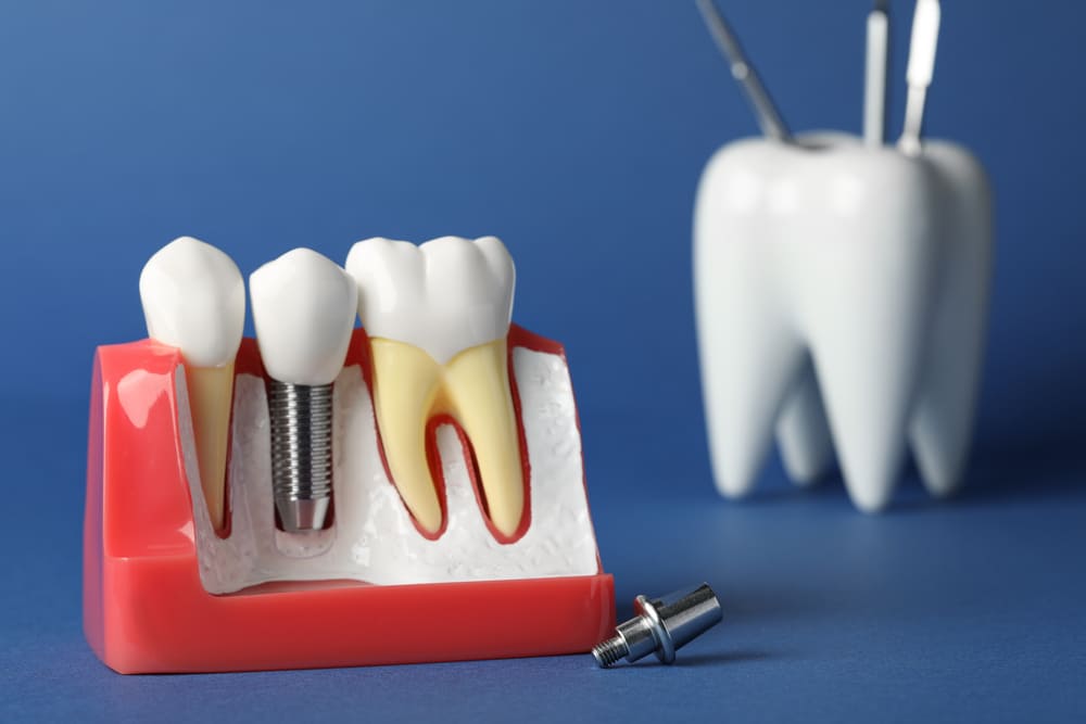 Importancia de la coordinación entre especialistas en rehabilitación oral completa en Panamá